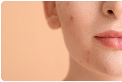 Traiter l'acné grâce au CBD 